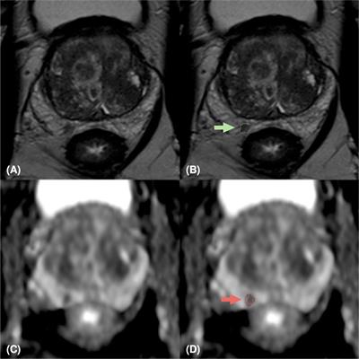 Machine and Deep Learning Prediction Of Prostate Cancer Aggressiveness Using Multiparametric MRI